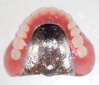 金属床の入れ歯