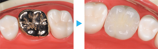 セラミックかぶせもの