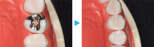 セラミックつめもの