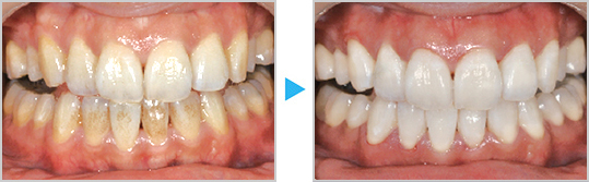 ホワイトニング