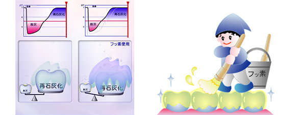 高濃度フッ素塗布