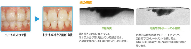 PMTCで常にツルツルな歯の表面を保つ